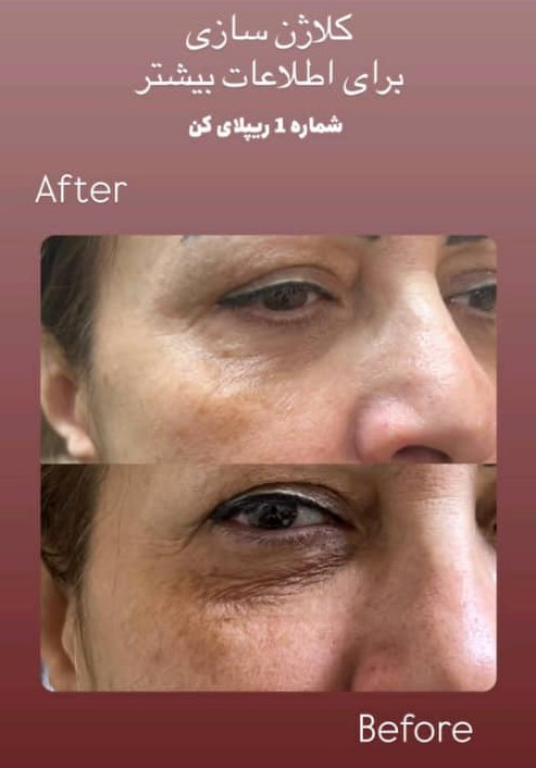 کلاژن سازی پوست